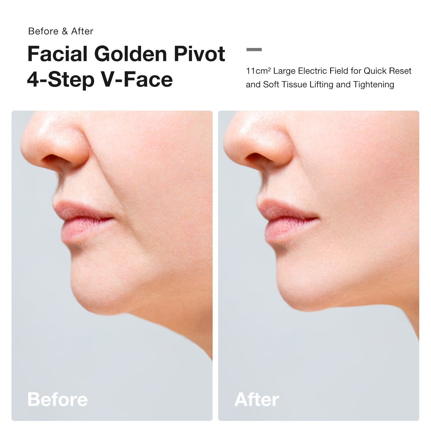 Before and after comparison showing JOVS Slimax in facial contouring and V-line creation with microcurrent therapy.